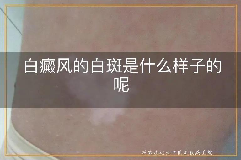 白癜风的白斑是什么样子的呢