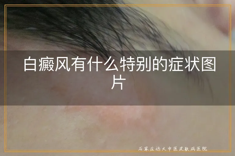 白癜风有什么特别的症状图片