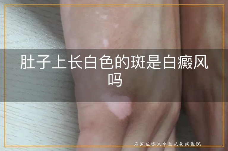 肚子上长白色的斑是白癜风吗