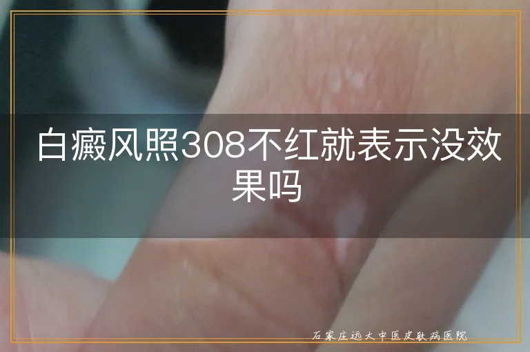 白癜风照308不红就表示没效果吗