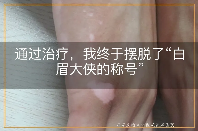 通过治疗，我终于摆脱了“白眉大侠的称号”