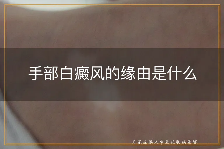 手部白癜风的缘由是什么