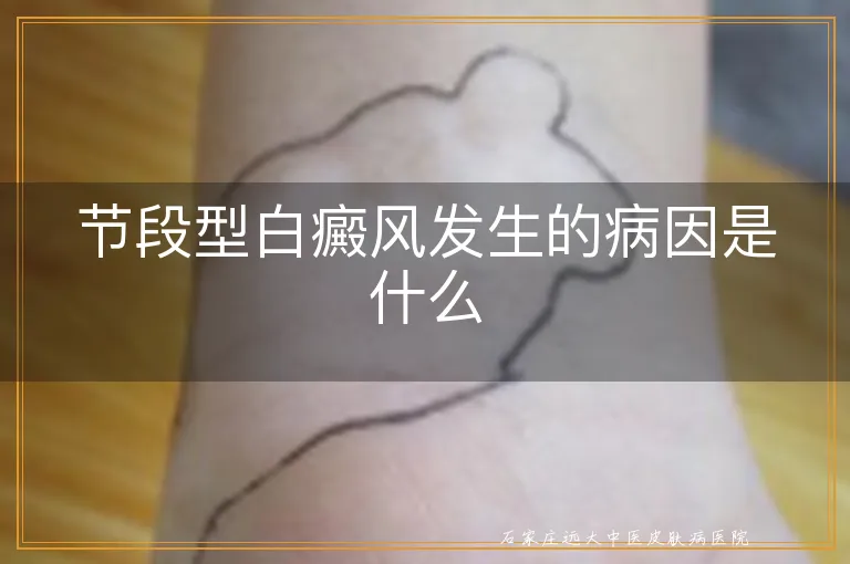 节段型白癜风发生的病因是什么