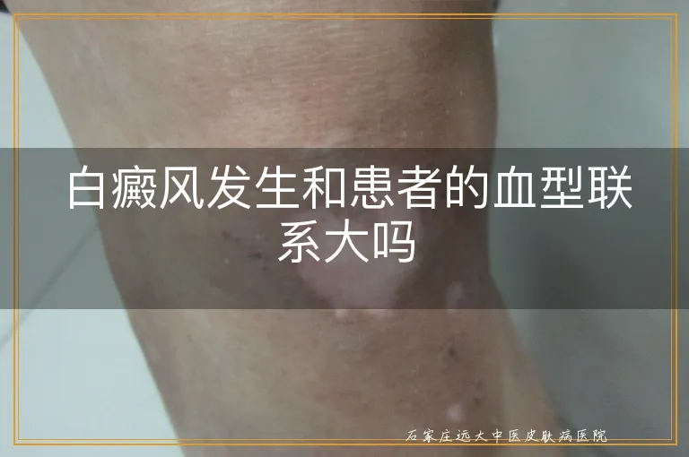 白癜风发生和患者的血型联系大吗