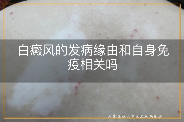 白癜风的发病缘由和自身免疫相关吗