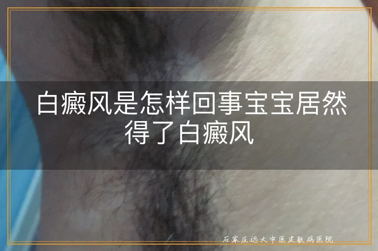 白癜风是怎样回事宝宝居然得了白癜风