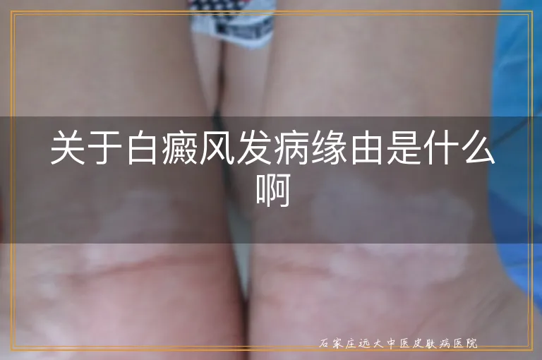 关于白癜风发病缘由是什么啊