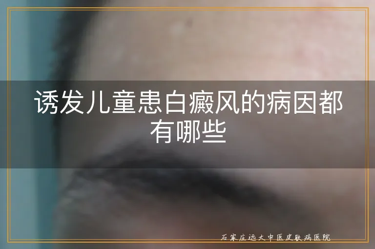 诱发儿童患白癜风的病因都有哪些