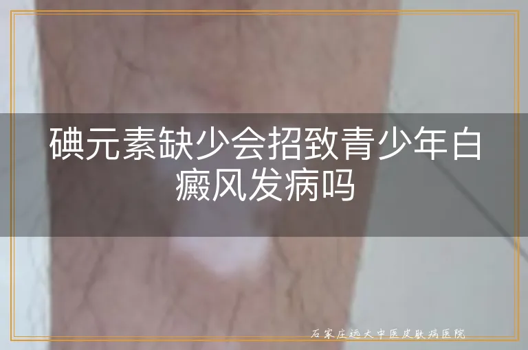 碘元素缺少会招致青少年白癜风发病吗