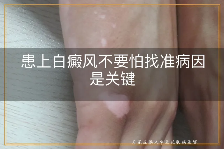 患上白癜风不要怕找准病因是关键