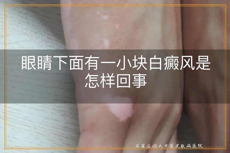 眼睛下面有一小块白癜风是怎样回事