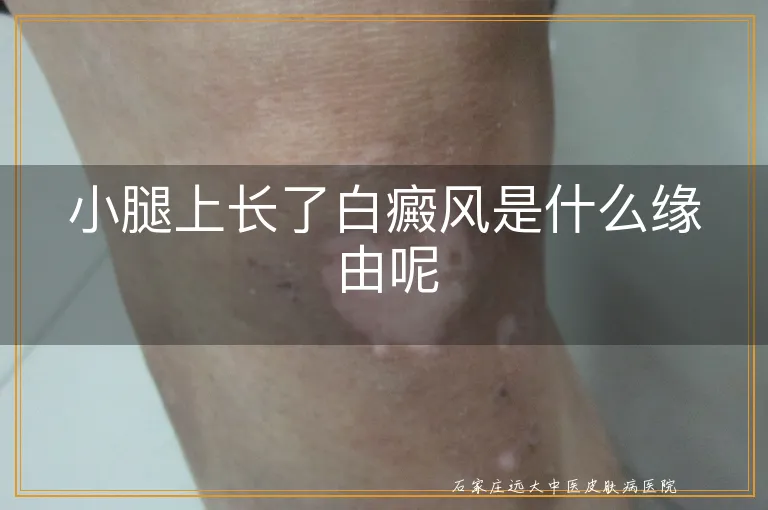 小腿上长了白癜风是什么缘由呢