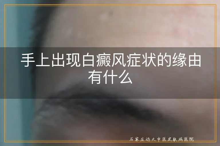 手上出现白癜风症状的缘由有什么