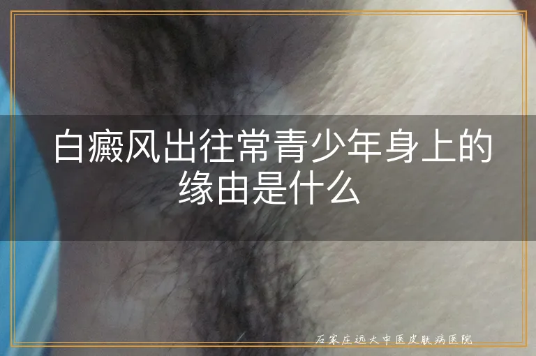 白癜风出往常青少年身上的缘由是什么