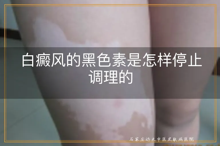 白癜风的黑色素是怎样停止调理的