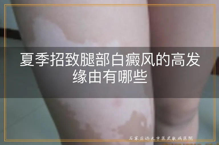 夏季招致腿部白癜风的高发缘由有哪些