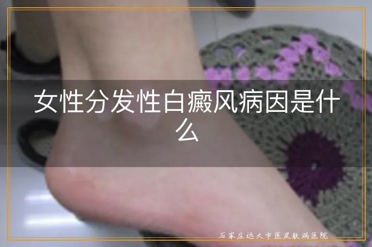 女性分发性白癜风病因是什么