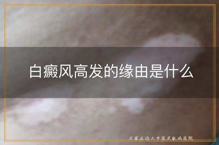 白癜风高发的缘由是什么