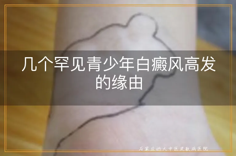 几个罕见青少年白癜风高发的缘由