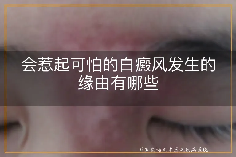 会惹起可怕的白癜风发生的缘由有哪些