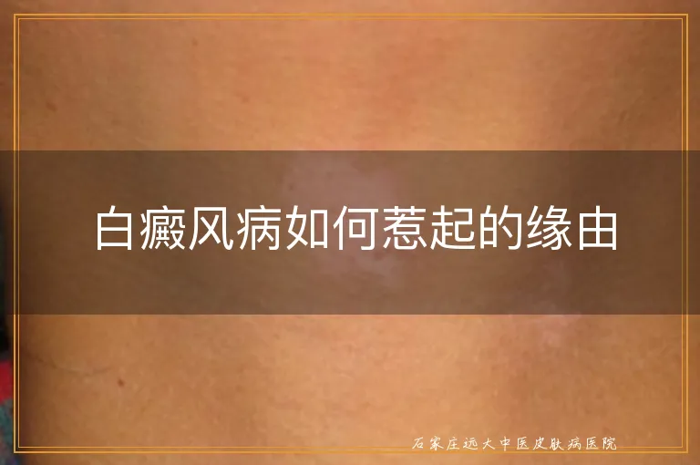 白癜风病如何惹起的缘由