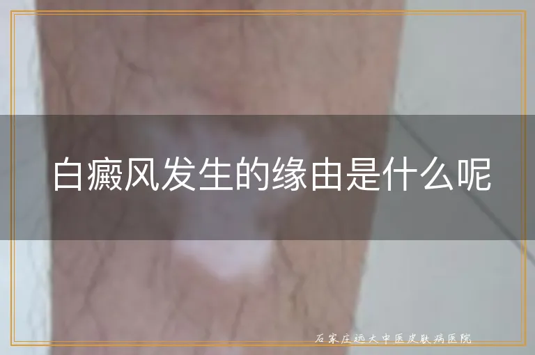 白癜风发生的缘由是什么呢