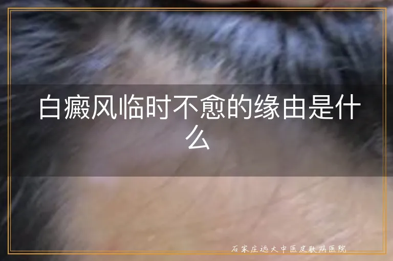 白癜风临时不愈的缘由是什么