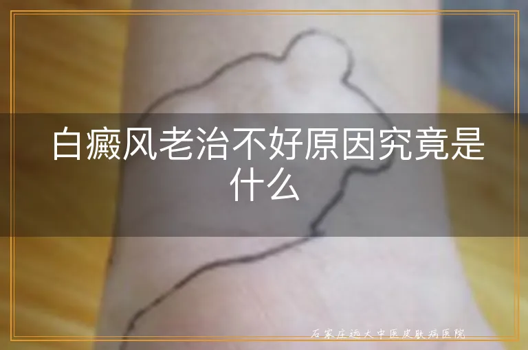 白癜风老治不好原因究竟是什么