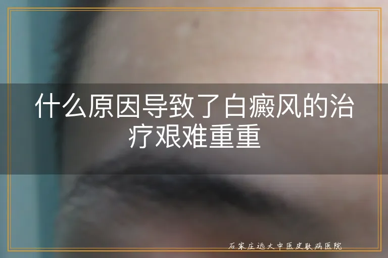 什么原因导致了白癜风的治疗艰难重重