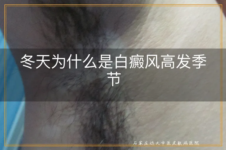 冬天为什么是白癜风高发季节