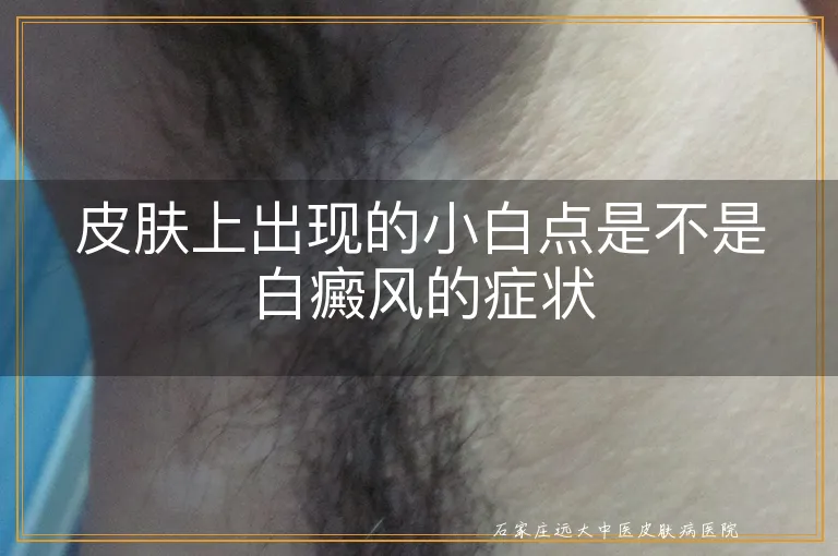 皮肤上出现的小白点是不是白癜风的症状