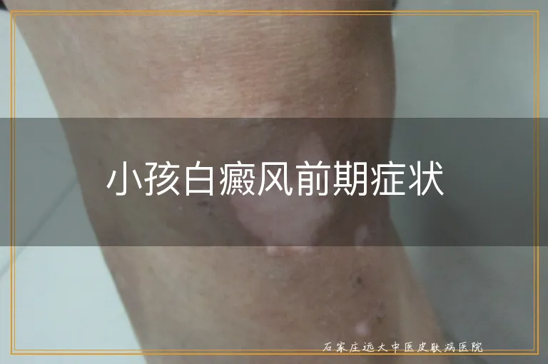 小孩白癜风前期症状