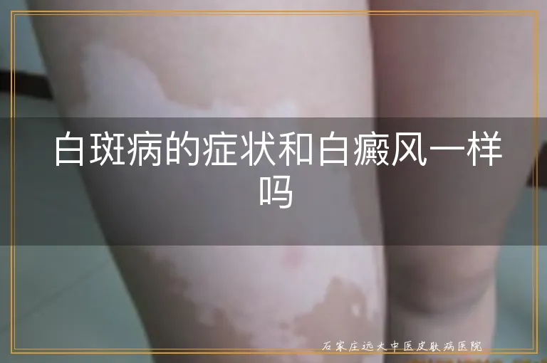 白斑病的症状和白癜风一样吗