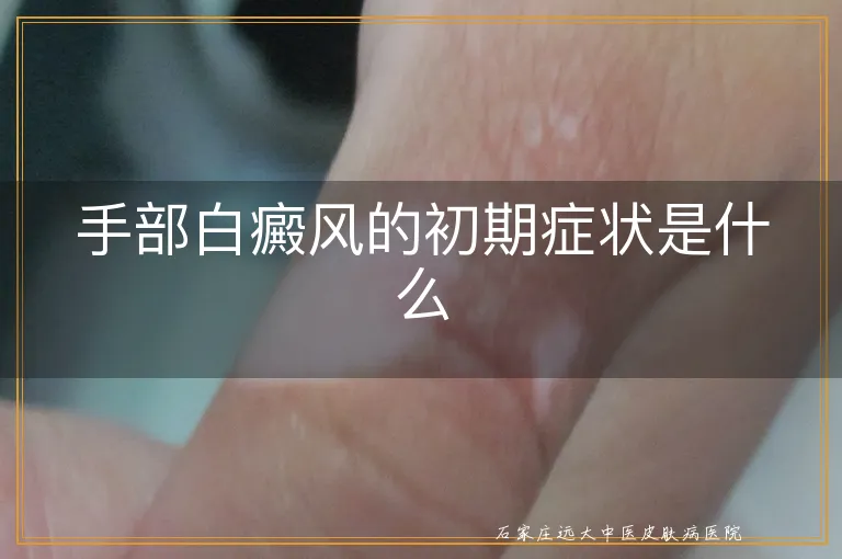 手部白癜风的初期症状是什么