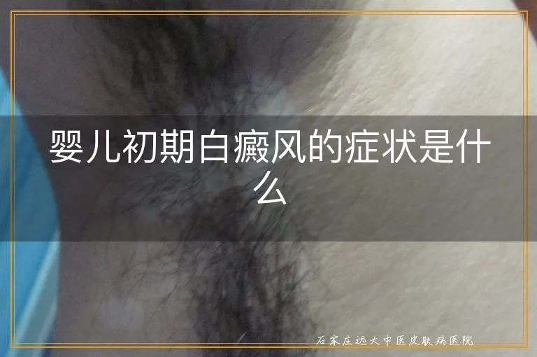 婴儿初期白癜风的症状是什么