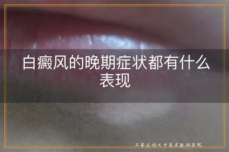 白癜风的晚期症状都有什么表现