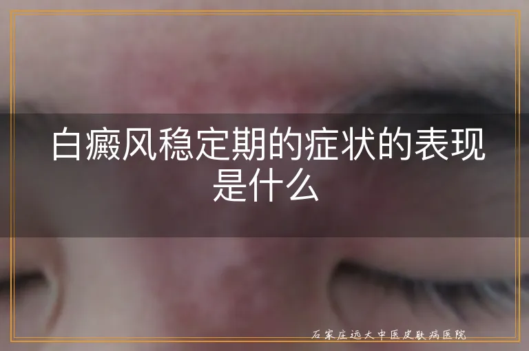 白癜风稳定期的症状的表现是什么