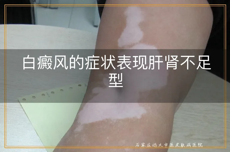 白癜风的症状表现肝肾不足型