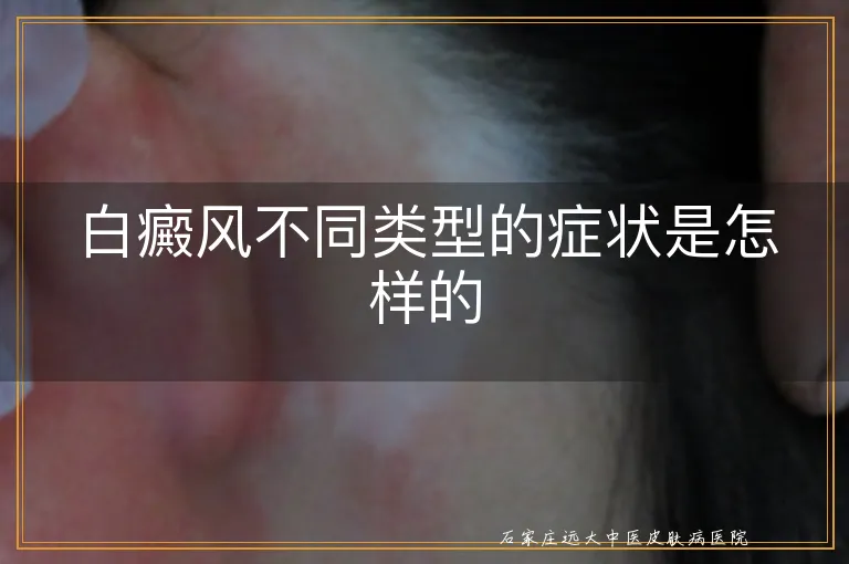 白癜风不同类型的症状是怎样的