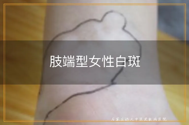 肢端型女性白斑