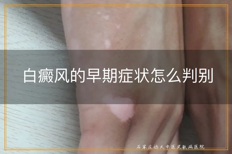 白癜风的早期症状怎么判别