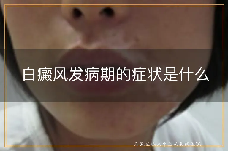 白癜风发病期的症状是什么