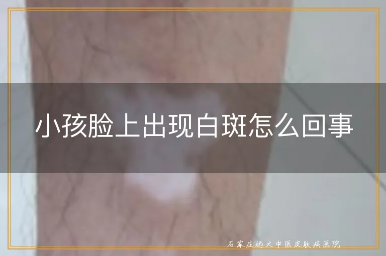 小孩脸上出现白斑怎么回事