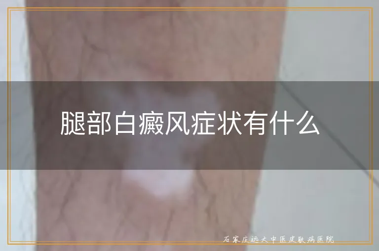 腿部白癜风症状有什么