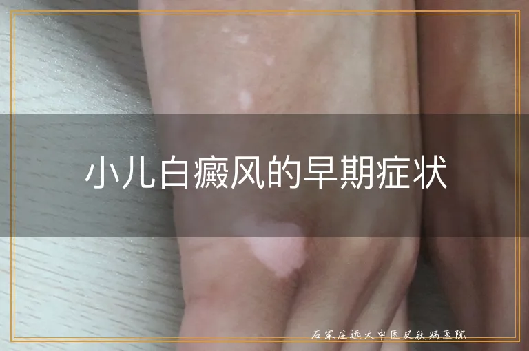 小儿白癜风的早期症状