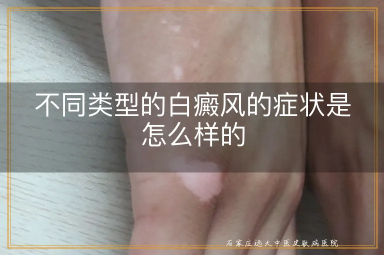 不同类型的白癜风的症状是怎么样的