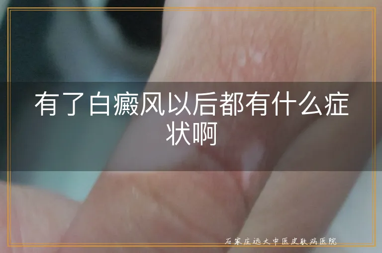 有了白癜风以后都有什么症状啊