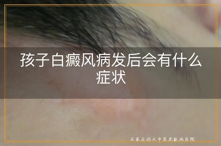 孩子白癜风病发后会有什么症状