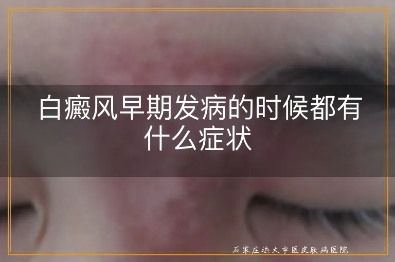 白癜风早期发病的时候都有什么症状