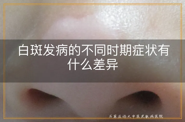 白斑发病的不同时期症状有什么差异